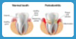 Periodontitis