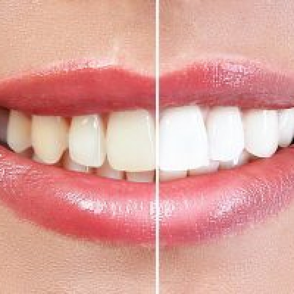 Is it true that bleaching destroys the enamel of my teeth?