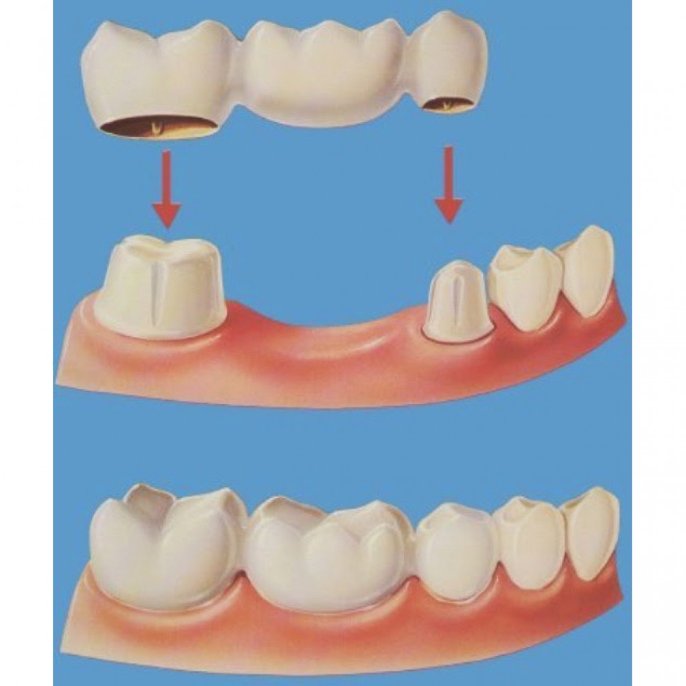 PARTIAL DENTURE («BRIDGE»)