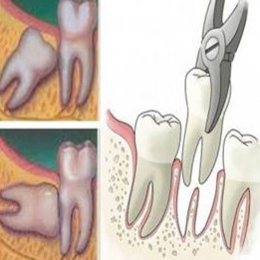 EXTRACTIONS-IMPACTED/SEMI- IMPACTED WISDOM TEETH