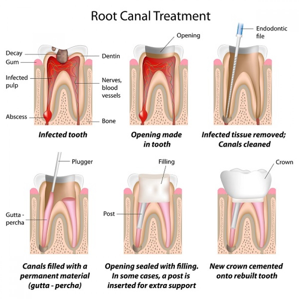 ENDODONTICS