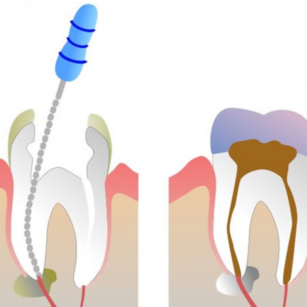 Why and when do I need endodontic treatment (denervation)?