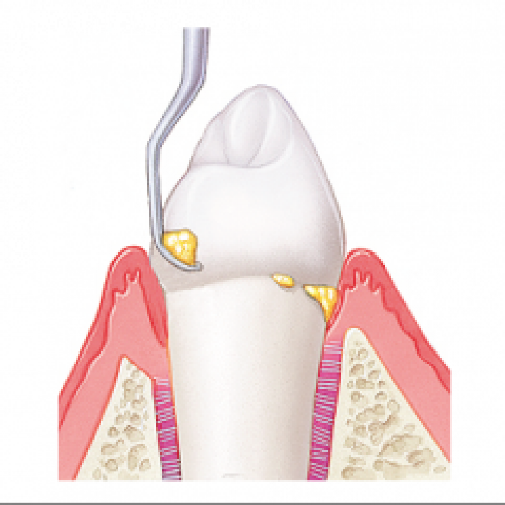 TARTAR REMOVAL OF TEETH CLEANING