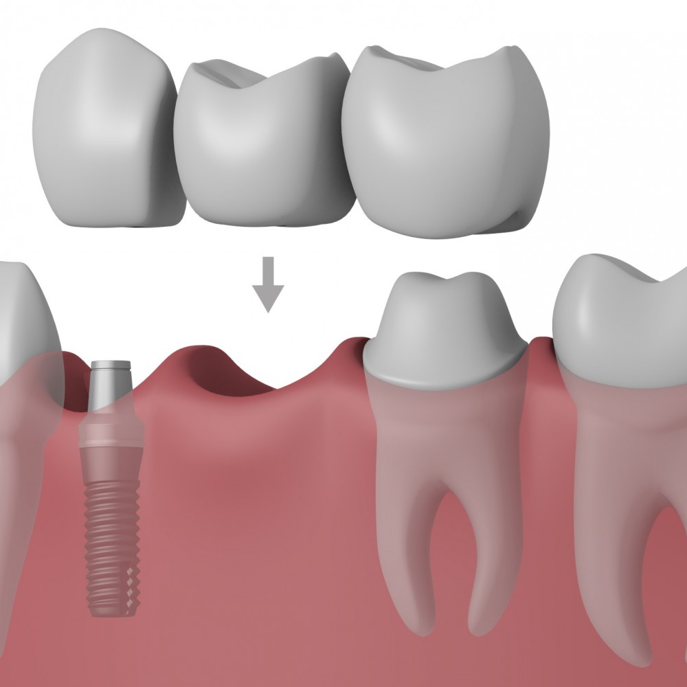 Bridge, partial denture or implant?