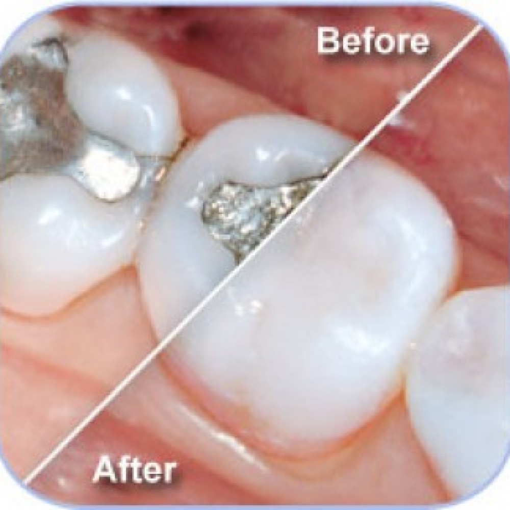 Is the filling with composite resin (white) or an amalgam (metallic) better?