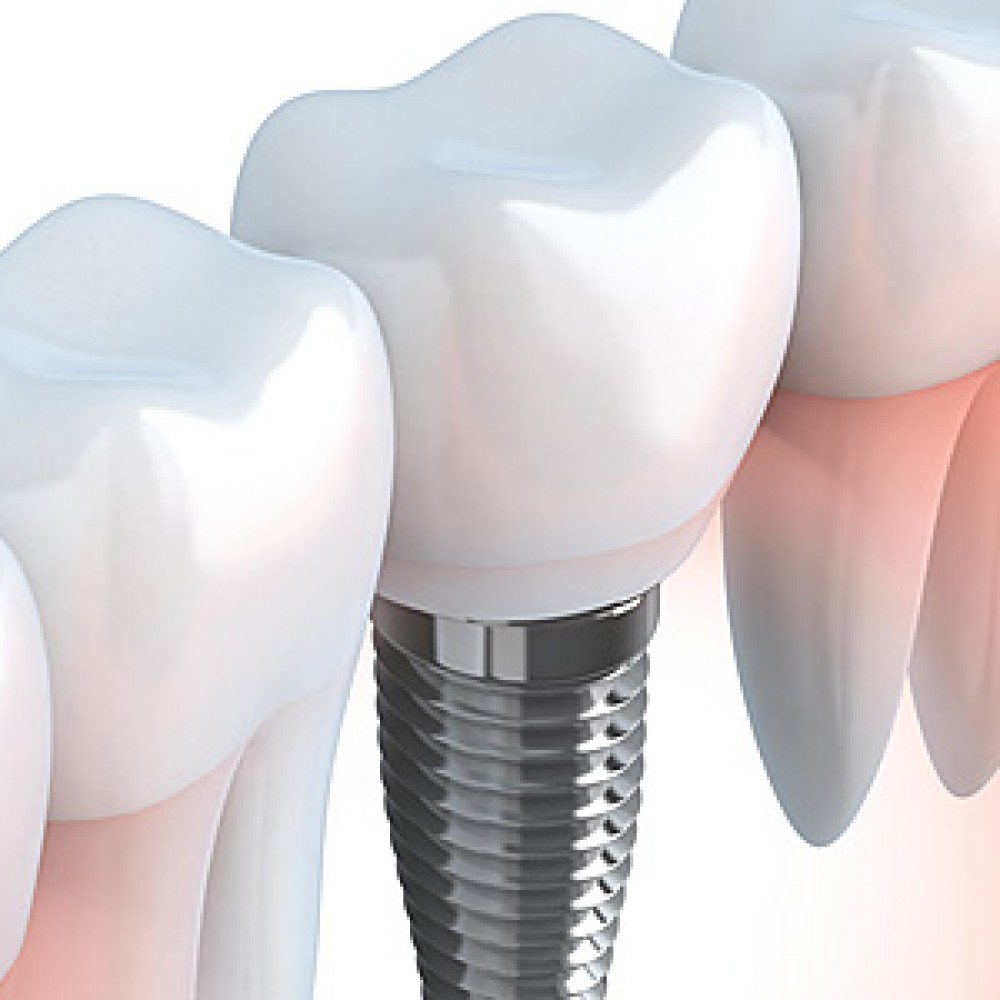 What is a dental implant and why is the periodontist considered as the best suited person for its placement?