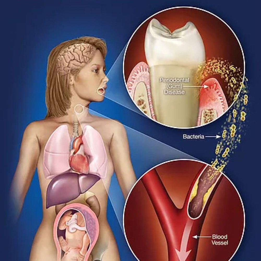 Is periodontitis associated with other health problems?