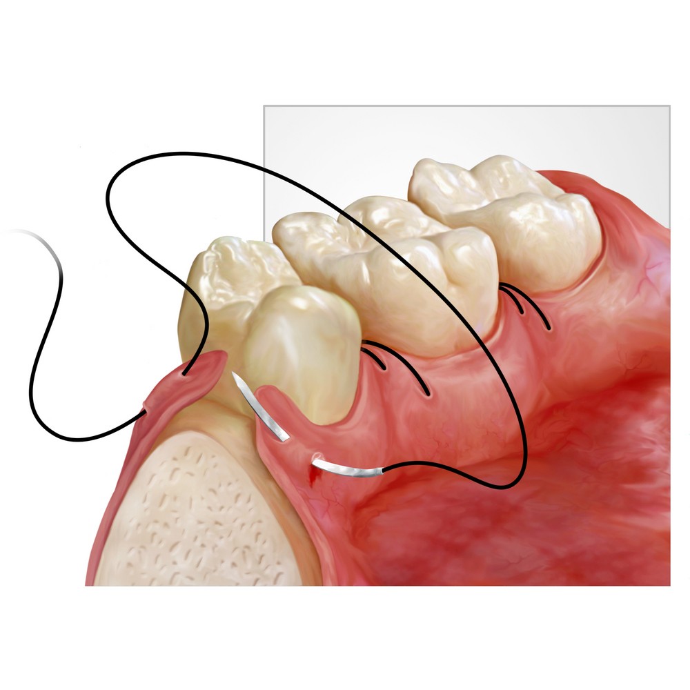 GINGIVOPLASTY- GINGIVECTOMY – AESTHETICS OF THE PERIODONTIUM