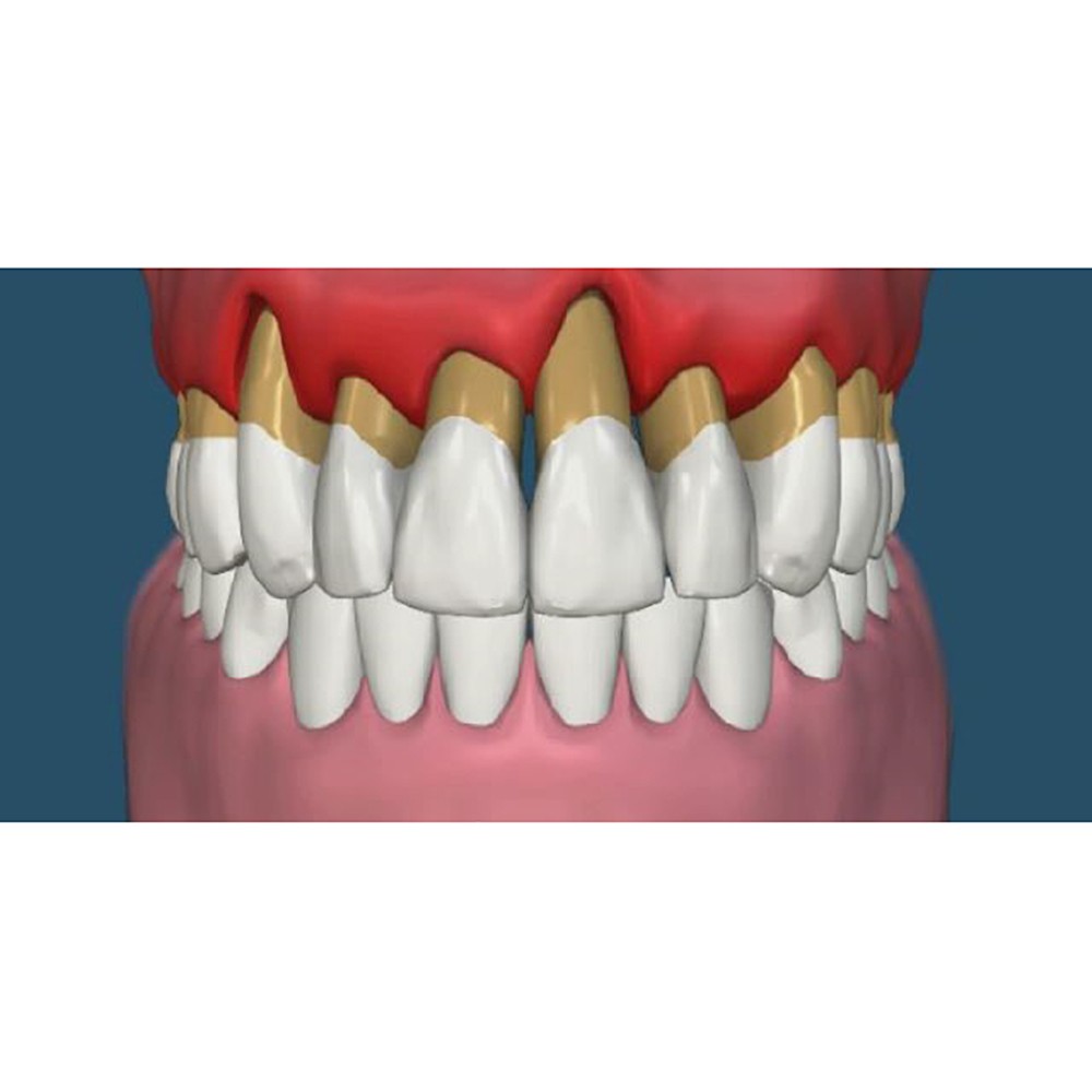 PERIODONTITIS