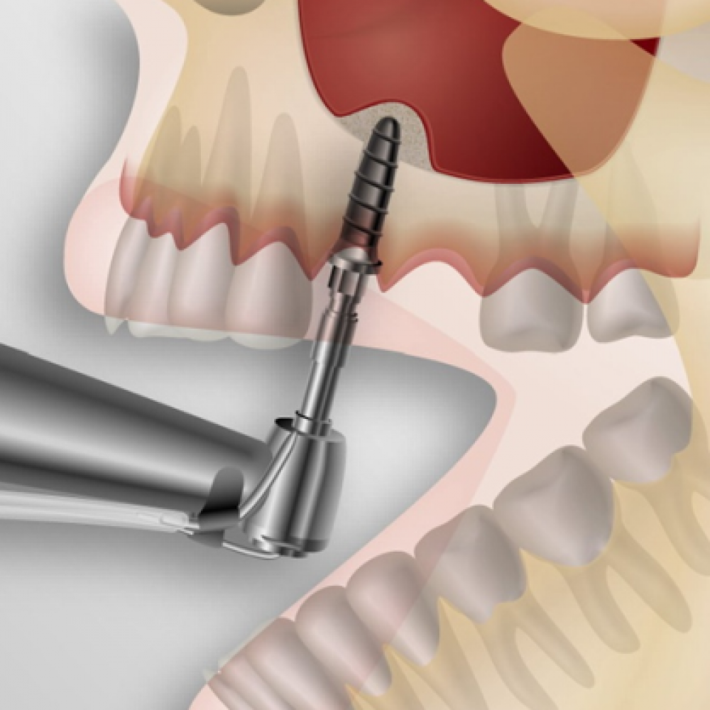 SINUS LIFT