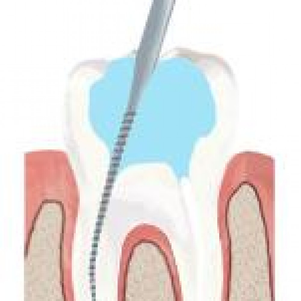 What is endodontic treatment?